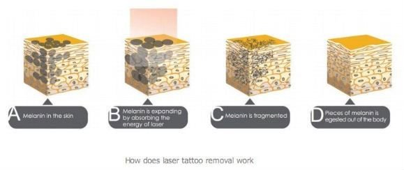Système professionnel de retrait de tatouage de laser de yag de ND de commutateur de la clinique q avec la grande promotion