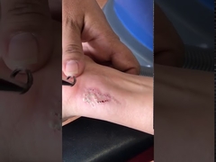 Dispositif efficace de retrait de tatouage de laser de ND Yag Q de commutateur puissant de Y6