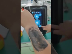 P9 Nd Yag Laser Picosecond Laser Détachement de tatouage