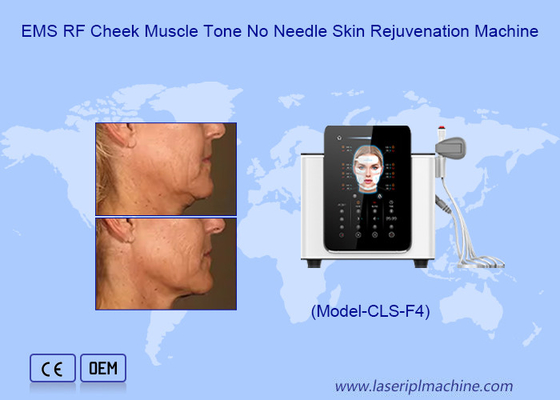 Réduction des rides du visage HiEMT machine avec 200μs de pouls et forme d'onde biphasique