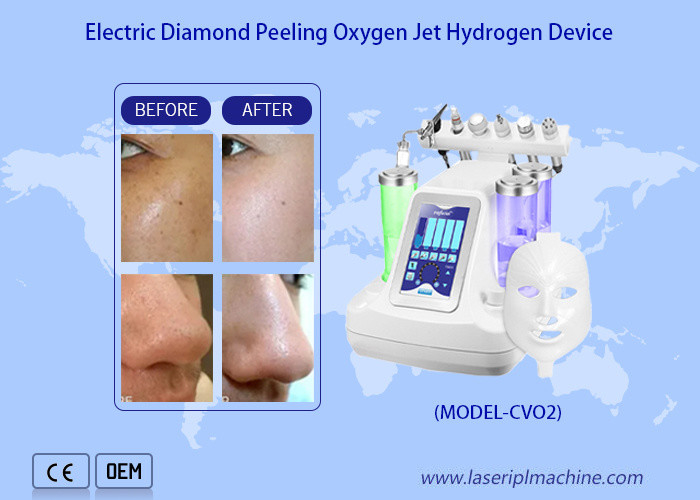 Nettoyage en profondeur du visage avec de l'eau, un jet d'oxygène, une peau à jet d'oxygène, une machine de peeling hydraulique, une dermabrasion à jet d'oxygène, un nettoyage en profondeur de la peau.